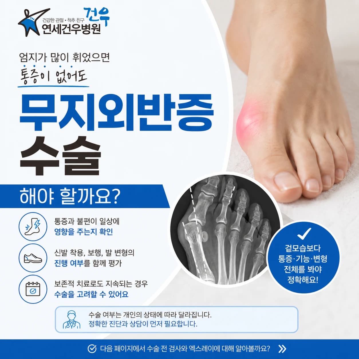 무지외반증 수술, 통증이 없어도 꼭 해야 할까요?