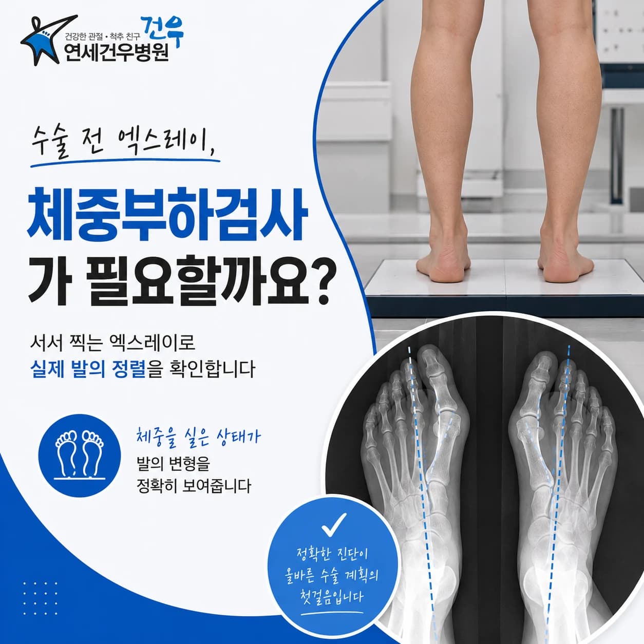 무지외반증 검사, 체중부하 엑스레이는 왜 필요할까요?