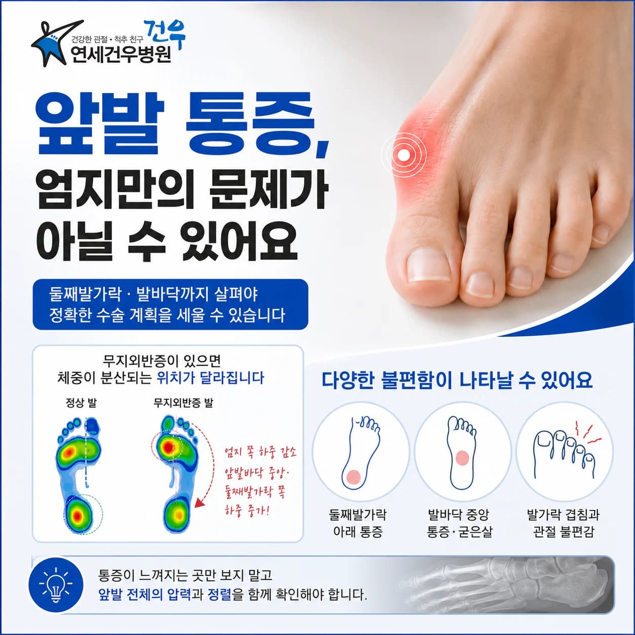 무지외반증과 앞발 통증, 엄지만의 문제일까요?