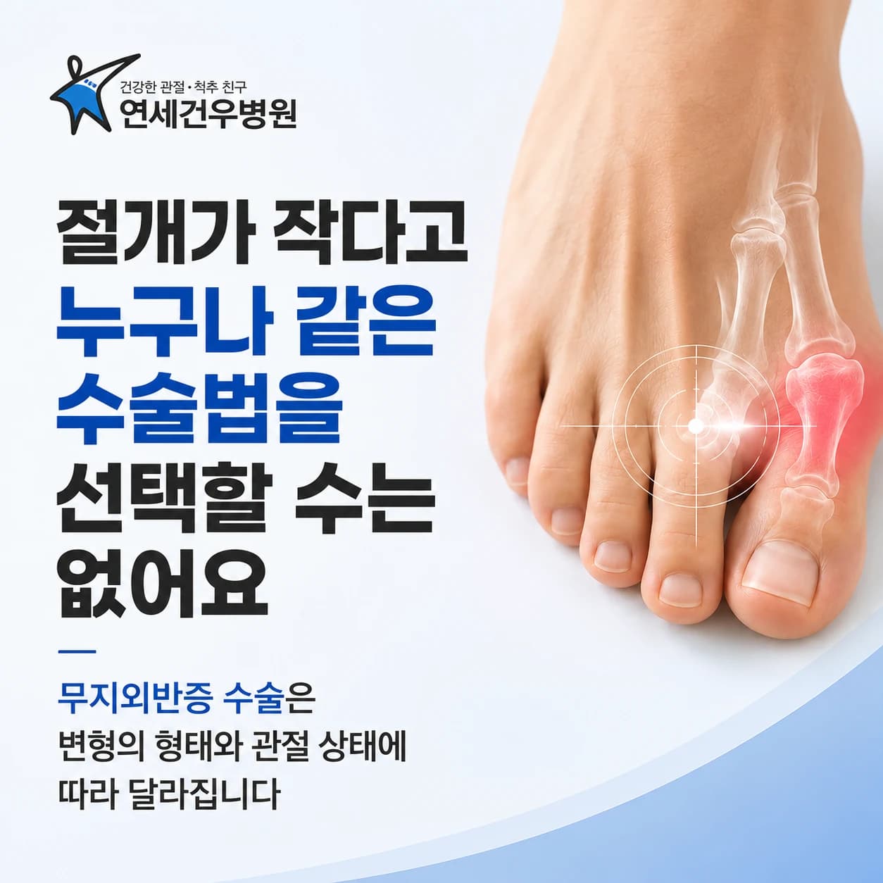 무지외반증 수술 방법, 절개 크기보다 무엇을 볼까요?