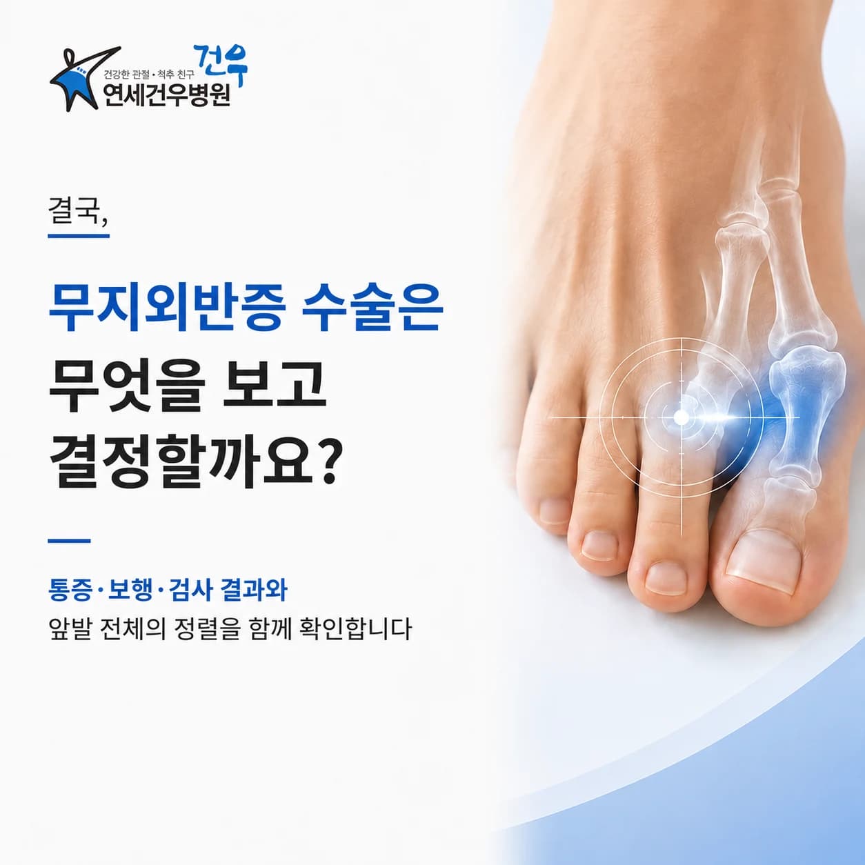 무지외반증 수술 결정 전 확인할 기준은 무엇일까요?